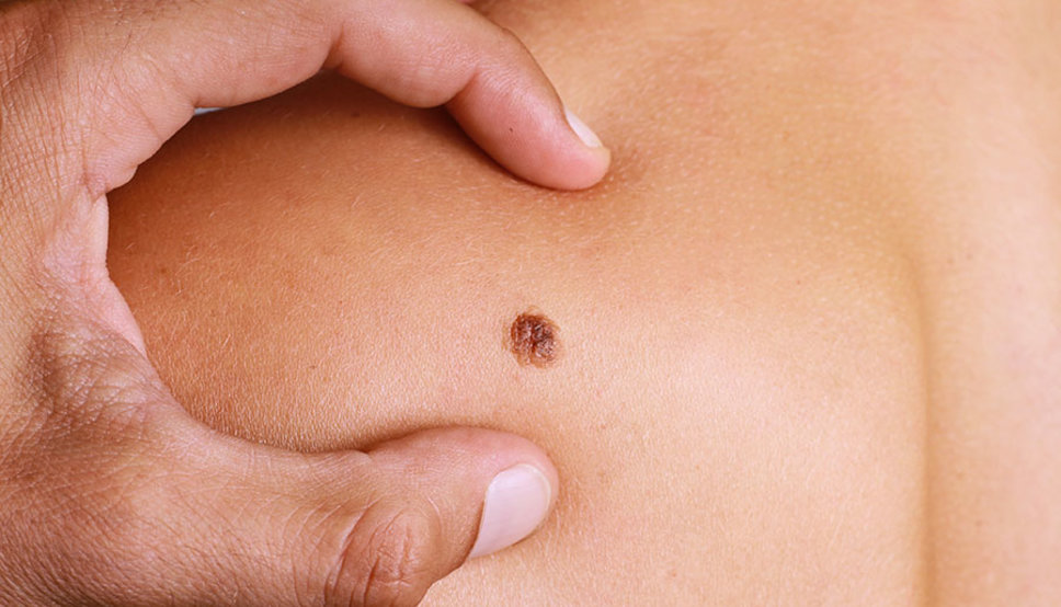 Why Skin Cancer Screening is Worth Considering