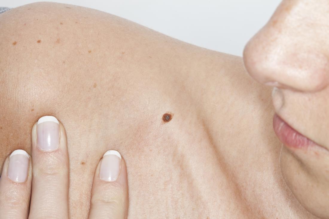 Common Misconceptions About Skin Moles