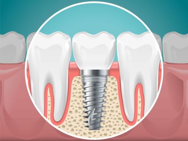 Answering 3 Key Questions About Dental Implants