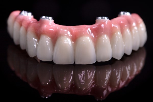 The Benefits of Implant-Supported Dentures over Traditional Dentures