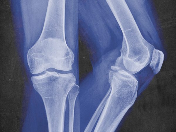 Bone Fracture Facts You Need to Know 
