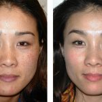 How To Quickly Remove Pigmentation From The Face