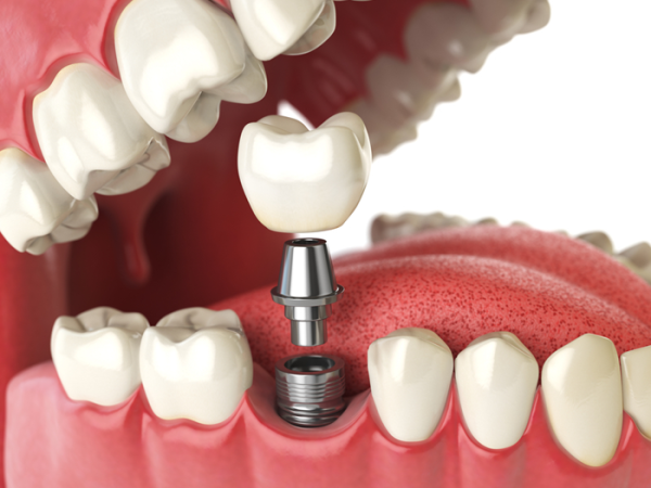 Who Should Consider Getting Dental Implants?