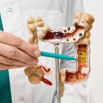 What to Expect After a Colonoscopy