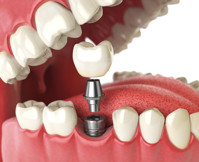 Do You Know These Dental Implants’ Top Benefits?