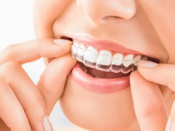 3 Advantages Of Visiting A Private Dentist For Invisalign Treatment