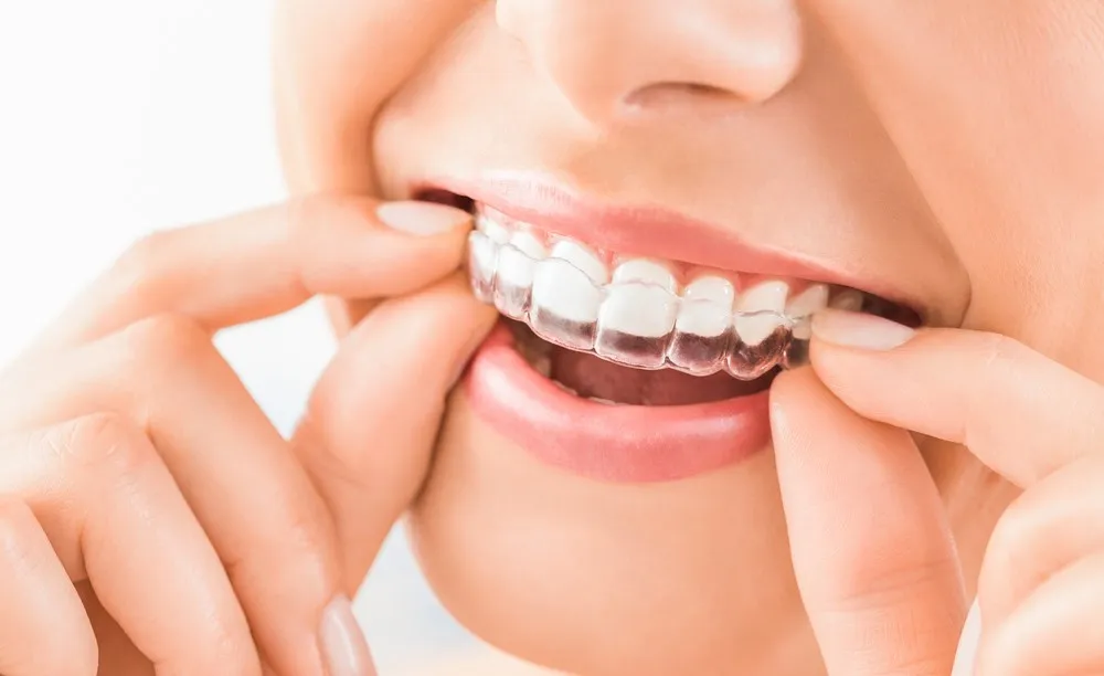 3 Advantages Of Visiting A Private Dentist For Invisalign Treatment