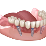 What Will Lead To a Successful Dental Implant Surgery?
