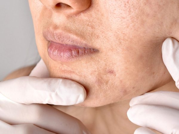 Pico Laser for Acne Scars: A Comprehensive Guide