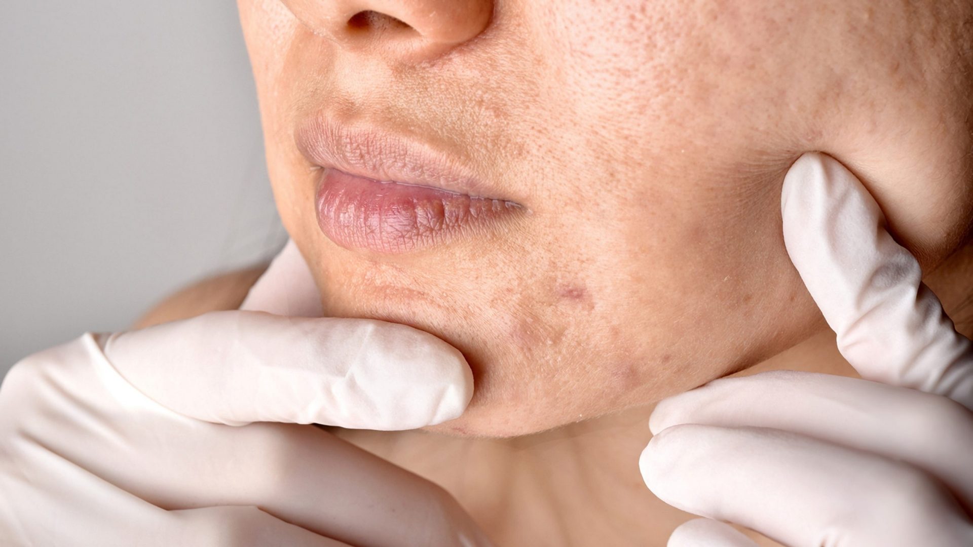 Pico Laser for Acne Scars: A Comprehensive Guide