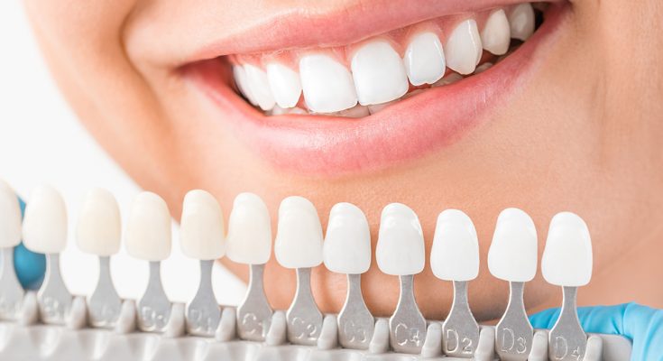 Porcelain Veneers